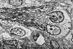 F,41y. | synovial metaplasia - capsule of implantate